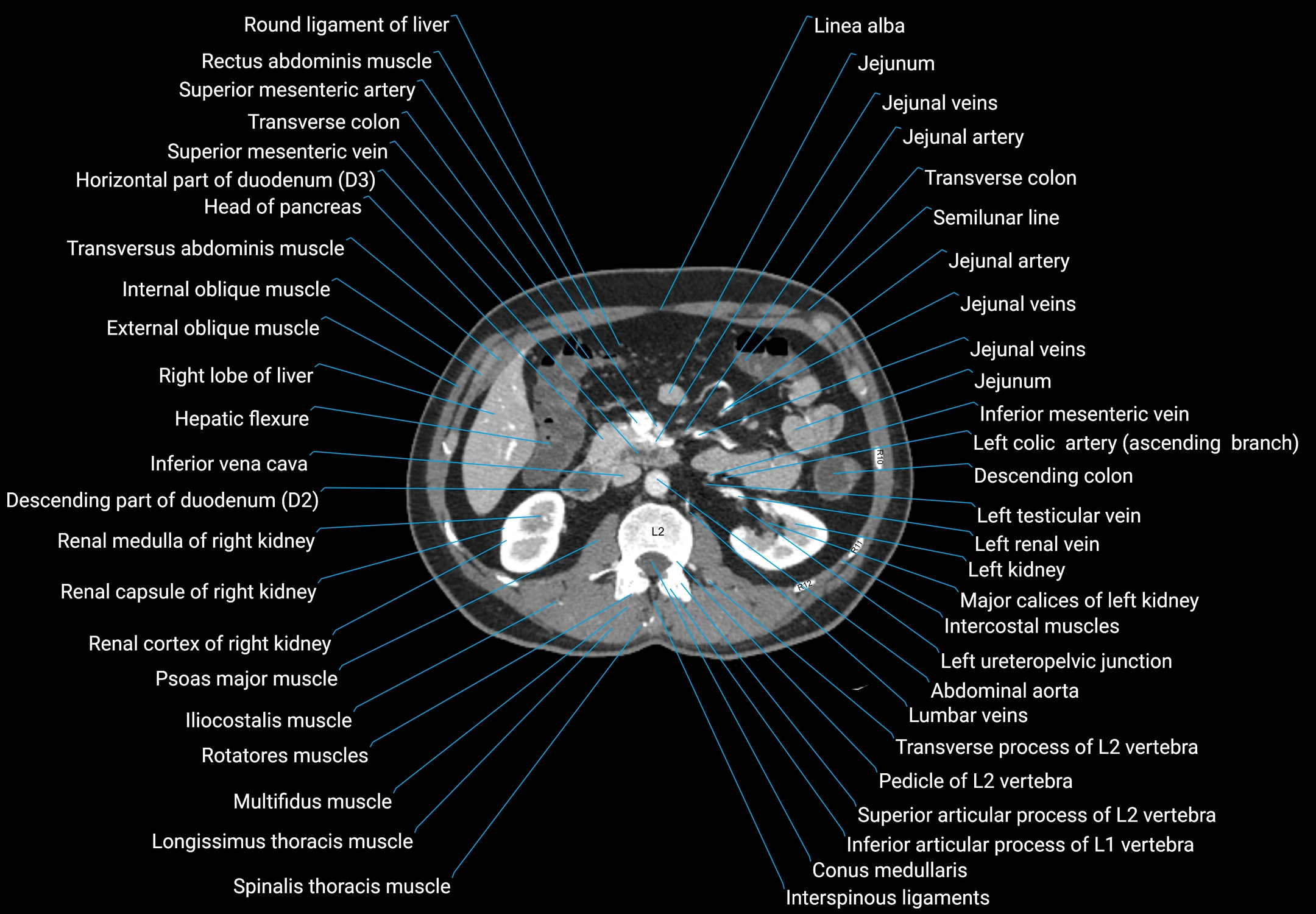 CT male pelvis axial cross sectional anatomy labelled radiology image -00070.webp